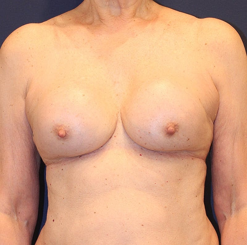 Breast Implant Revision Before & After