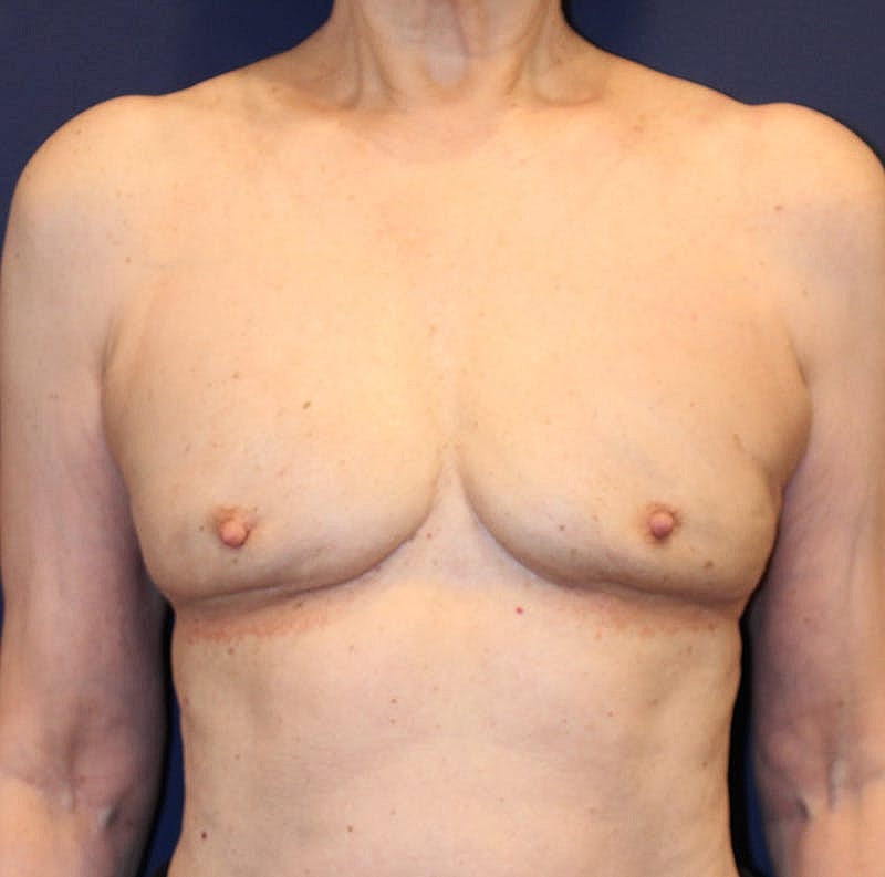 Breast Implant Revision Before & After