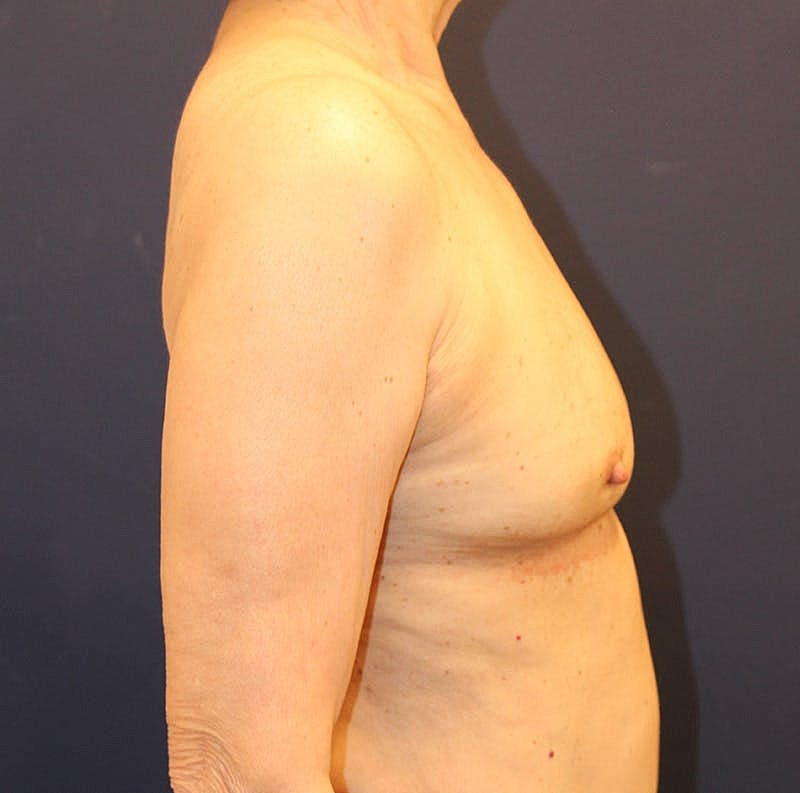 Breast Implant Revision Before & After