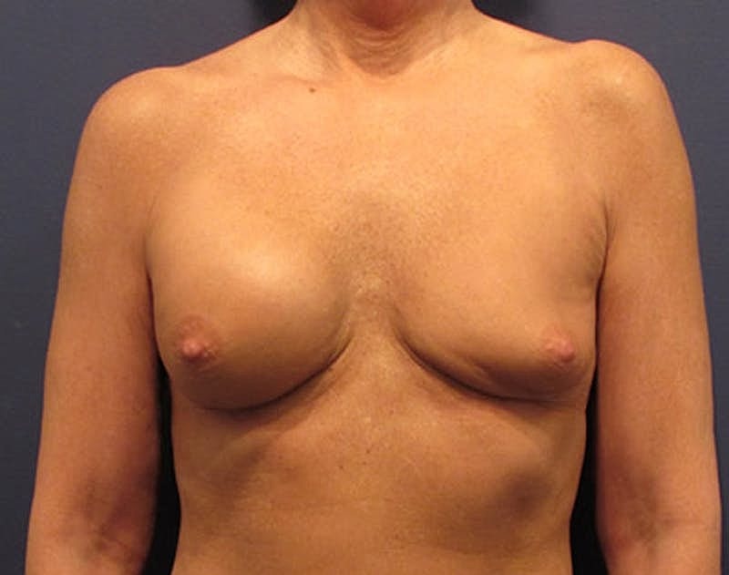 Breast Implant Revision Before & After