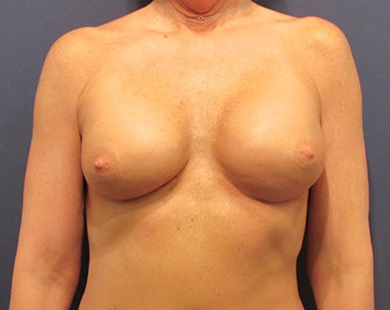 Breast Implant Revision Before & After