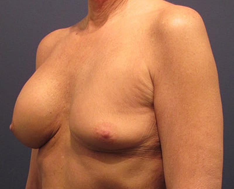 Breast Implant Revision Before & After