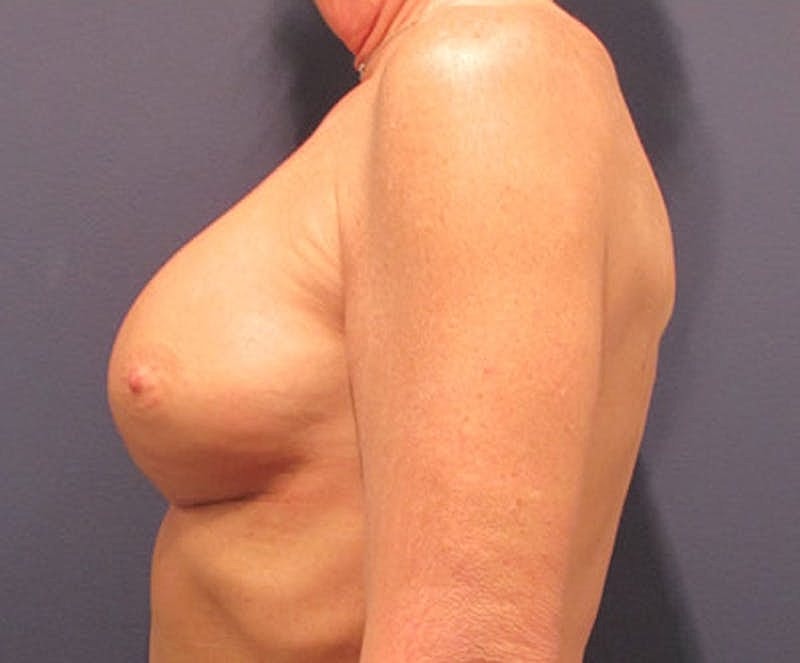 Breast Implant Revision Before & After