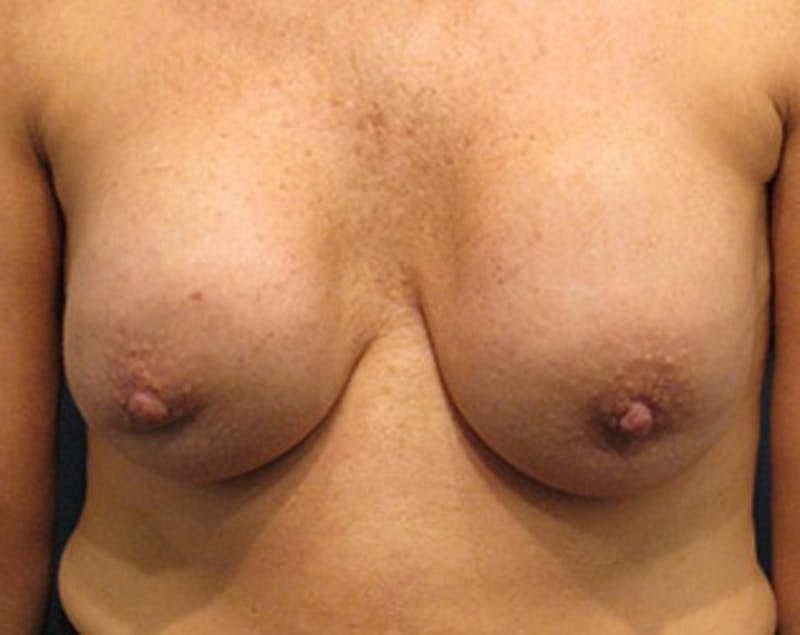 Breast Implant Revision Before & After