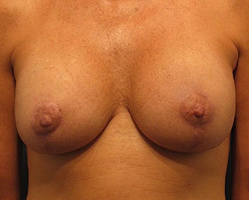 Breast Implant Revision Before & After