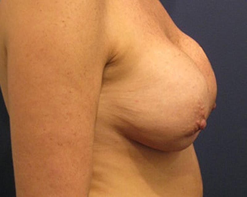 Breast Implant Revision Before & After