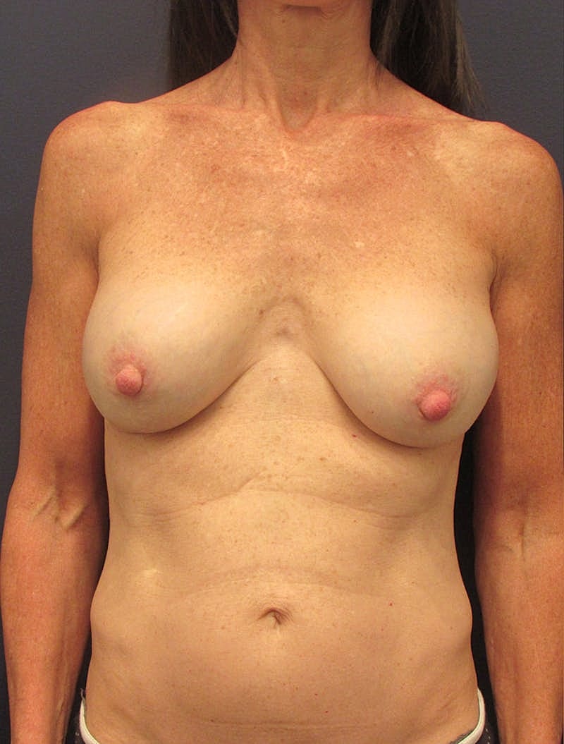 Breast Implant Revision Before & After