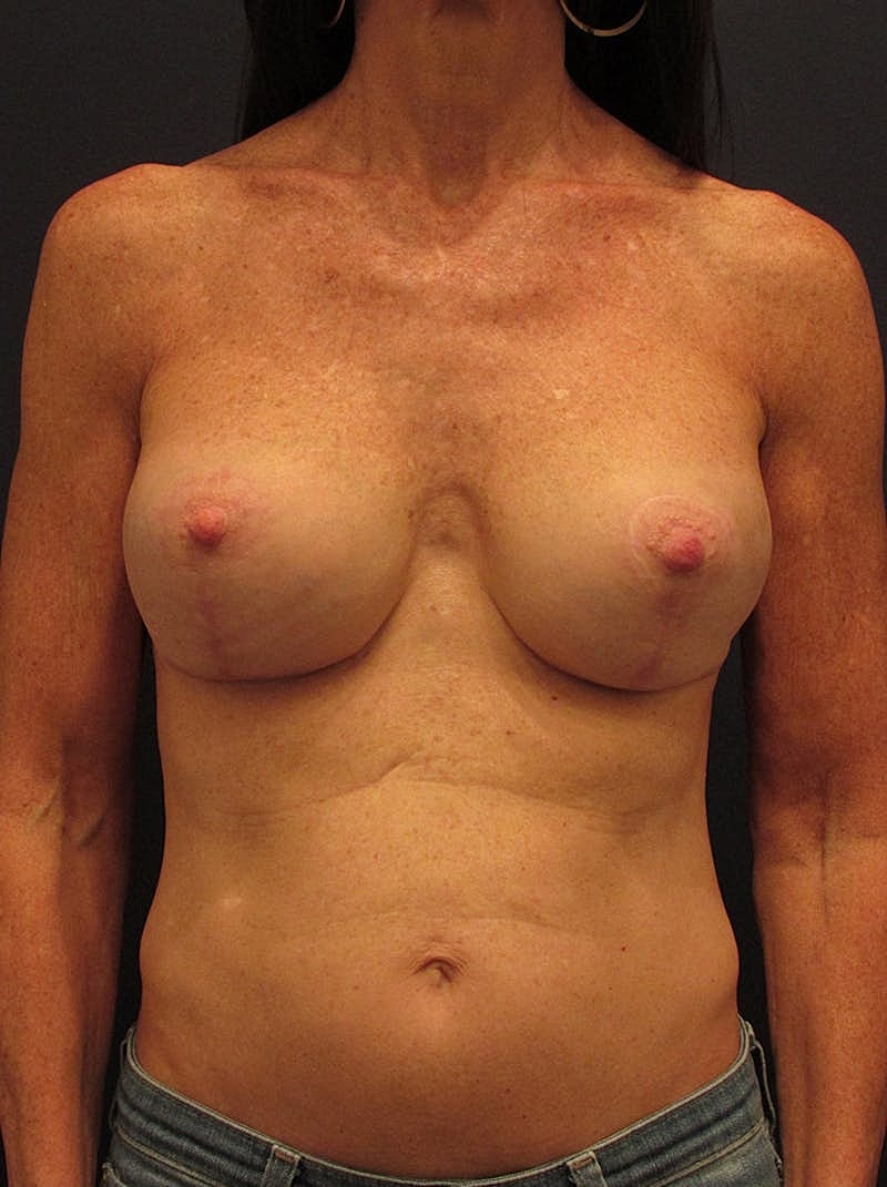 Breast Implant Revision Before & After