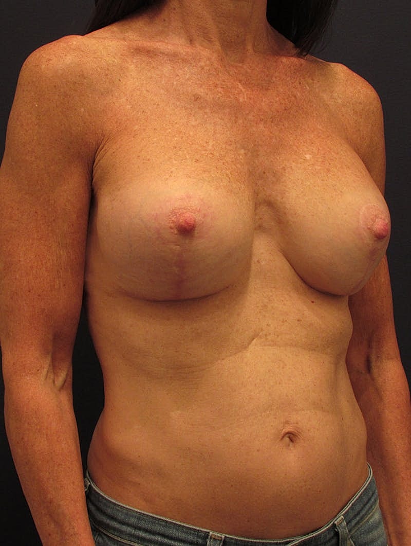 Breast Implant Revision Before & After