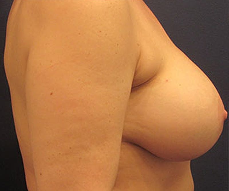 Breast Implant Revision Before & After