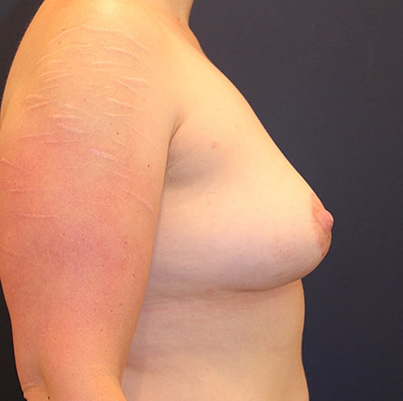 Breast Removal Explant Before & After