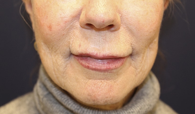 Lip Lift Gallery Before & After